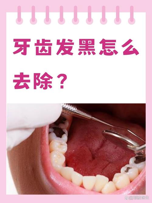牙齿黑污垢怎么去除 牙齿黑怎么办